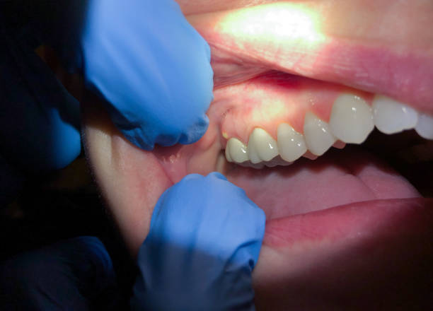 Best Emergency Denture Repair in Aumsville, OR